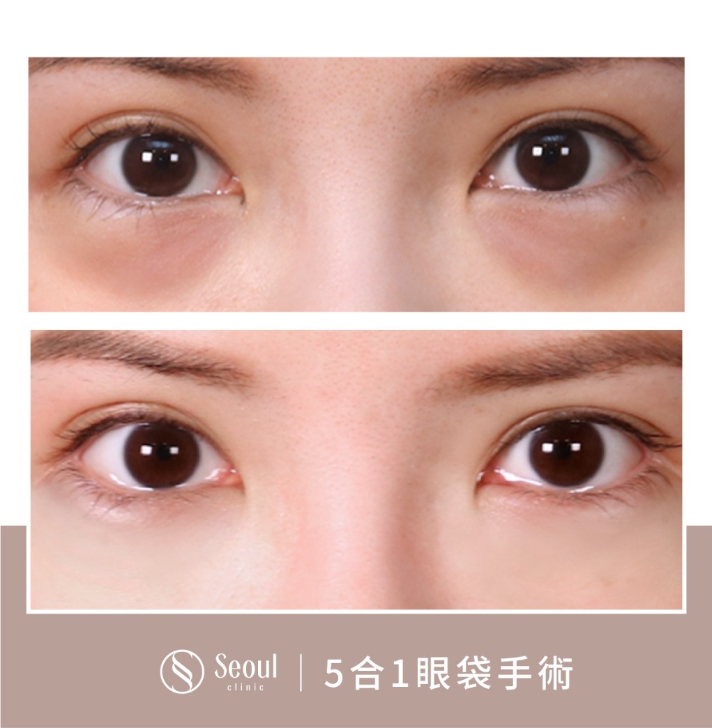 5合一眼袋手術分享-輕微浮腫的眼袋 → 眼袋內開手術後半年-首爾醫美診所