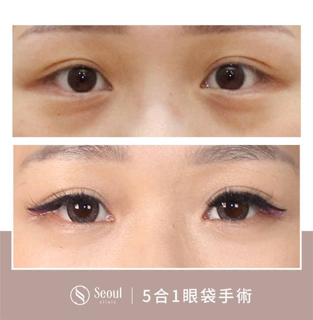 5合一眼袋手術分享-輕微結構式黑眼圈眼袋 → 眼袋內開手術後半年-首爾醫美診所