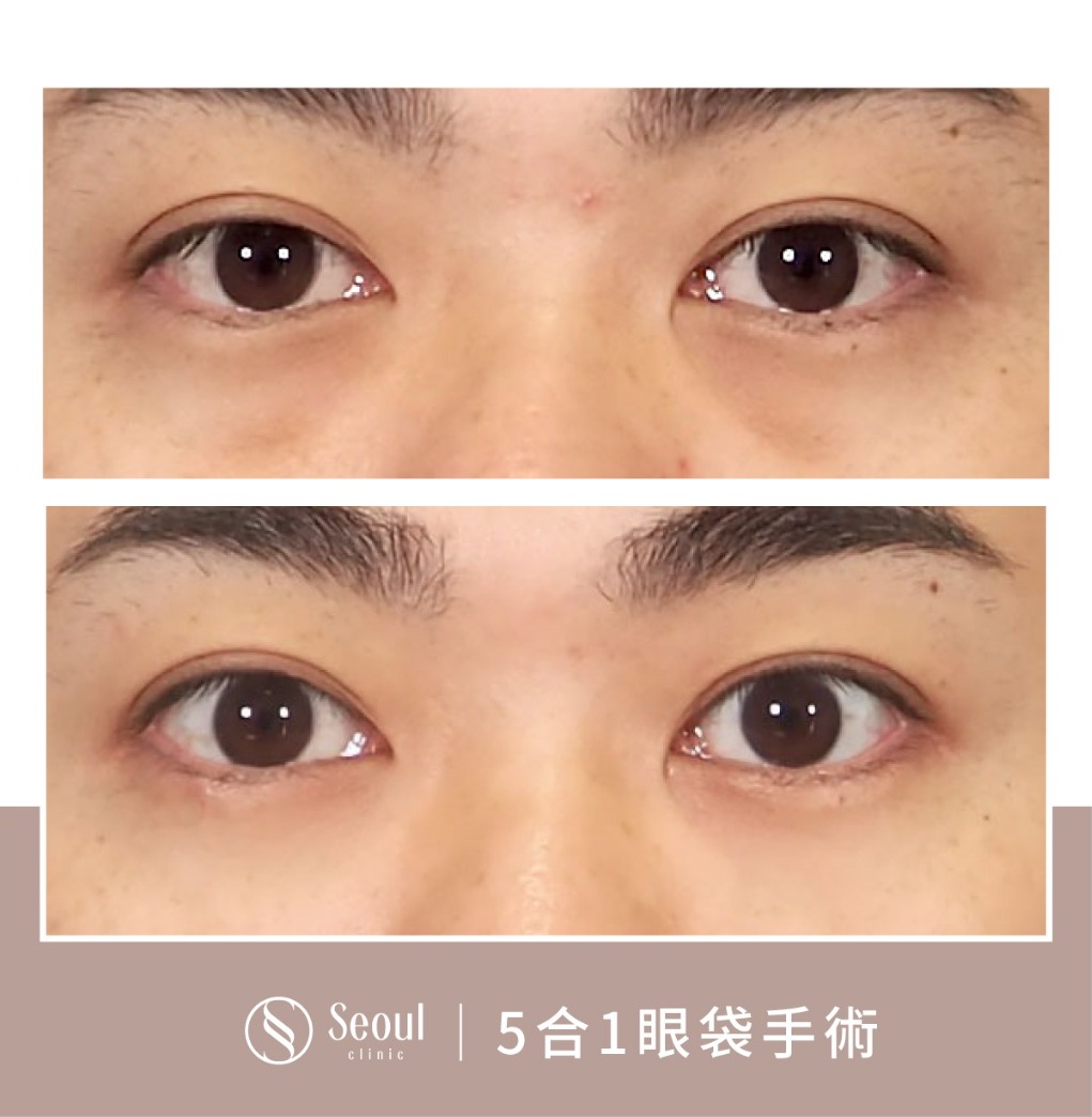 5合一眼袋手術分享-疲勞無神的眼袋→ 眼袋內開三個月-首爾醫美診所