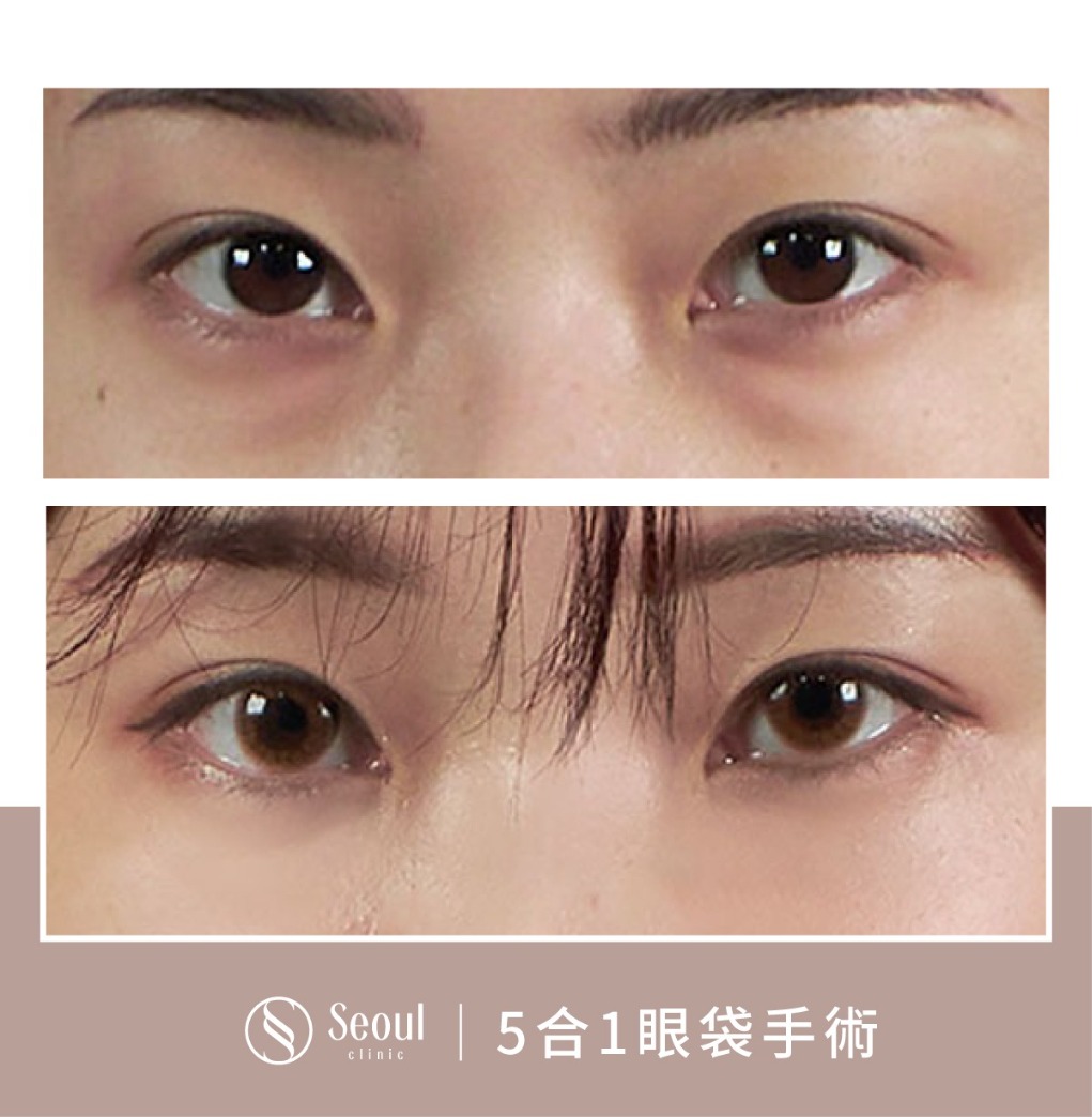 5合一眼袋手術分享-黑眼圈重結構式眼袋 → 眼袋內開手術後半年-首爾醫美診所