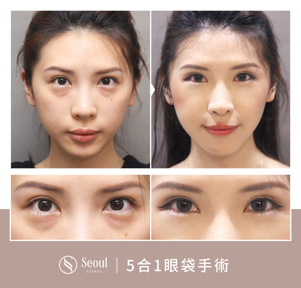 5合一眼袋手術分享-輕微浮腫的眼袋 → 眼袋內開手術後半年-首爾醫美診所