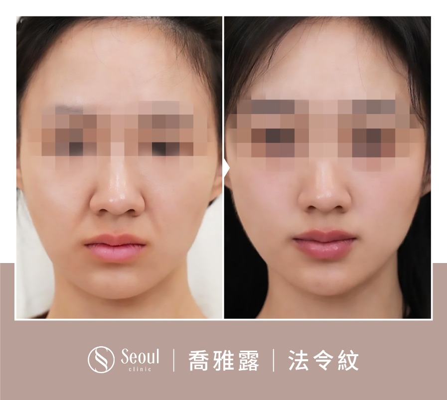喬雅露-喬雅露注射法令紋填補-首爾醫美診所 喬雅露-喬雅露注射法令紋填補-首爾醫美診所