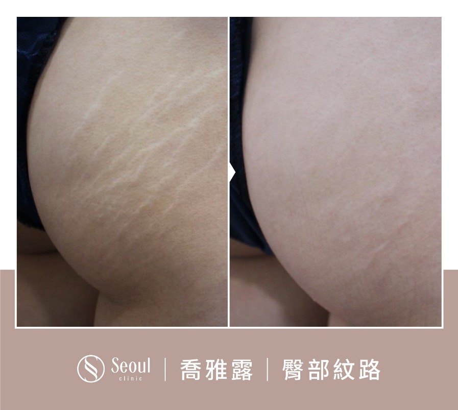喬雅露-喬雅露水光注射臀部橘皮案例-首爾醫美診所 喬雅露-喬雅露水光注射臀部橘皮案例-首爾醫美診所