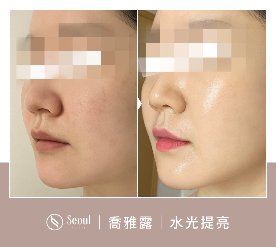 喬雅露-喬雅露水光注射案例-首爾醫美診所 喬雅露-喬雅露水光注射案例-首爾醫美診所