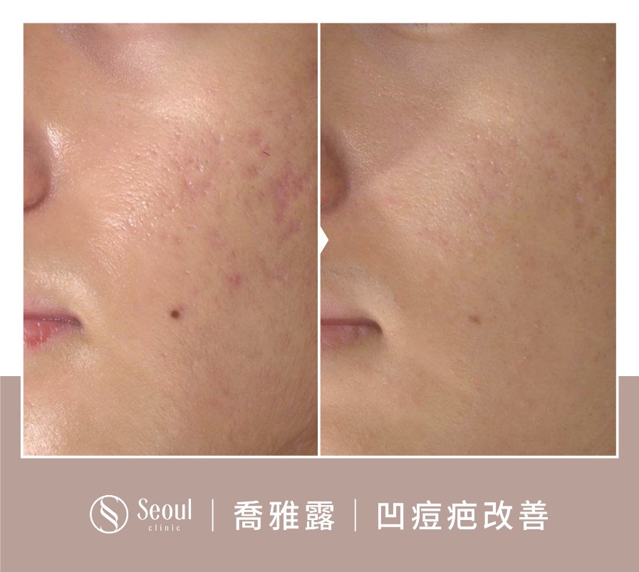 喬雅露-喬雅露水光注射凹疤改善案例-首爾醫美診所 喬雅露-喬雅露水光注射凹疤改善案例-首爾醫美診所