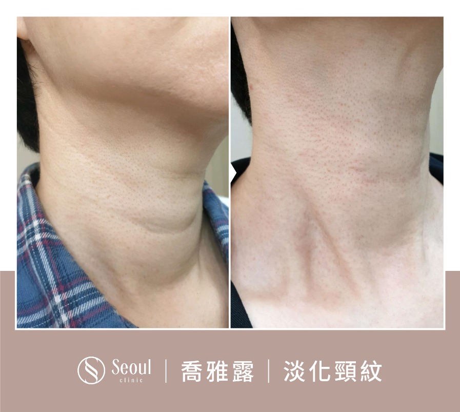 喬雅露-喬雅露注射淡化頸紋-首爾醫美診所 喬雅露-喬雅露注射淡化頸紋-首爾醫美診所