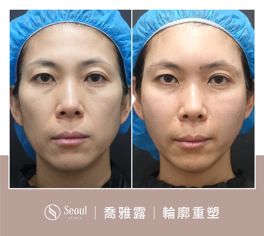 喬雅露-喬雅露注射輪廓重塑-首爾醫美診所 喬雅露-喬雅露注射輪廓重塑-首爾醫美診所