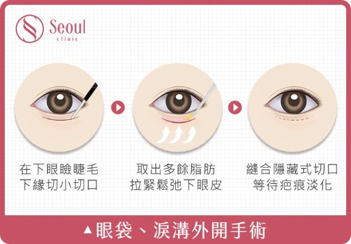 眼袋_外開型眼袋手術_首爾醫美診所