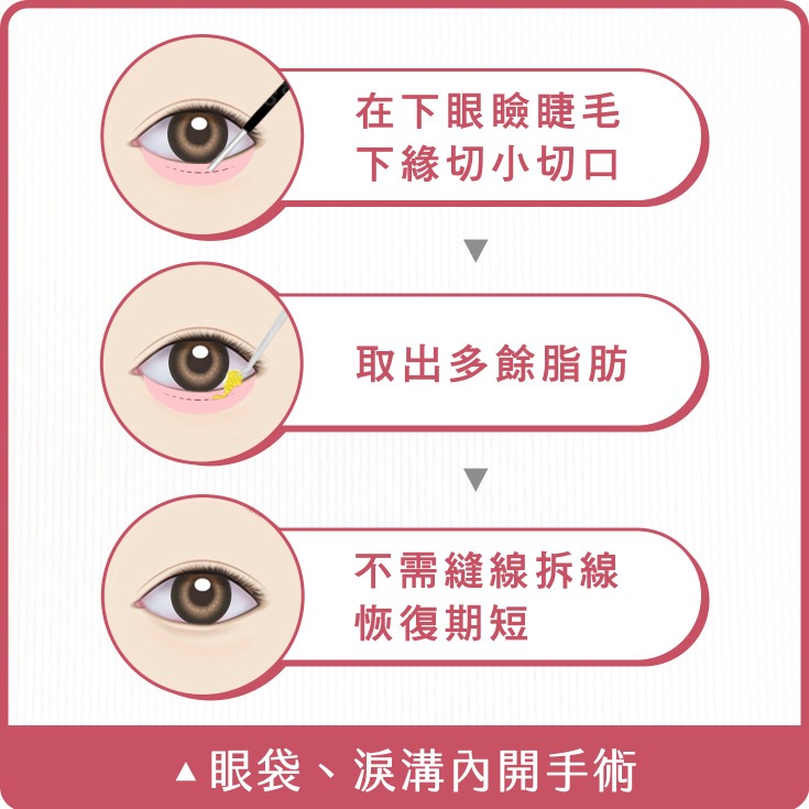 眼袋_內開型眼袋手術_首爾醫美診所