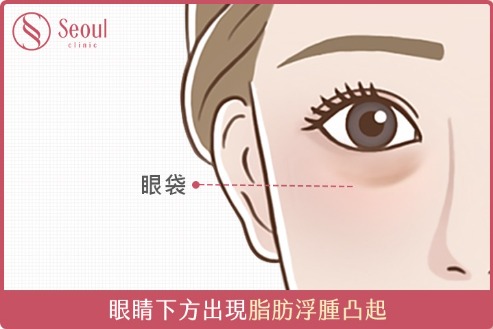 淚溝-眼袋是什麼？-首爾醫美
