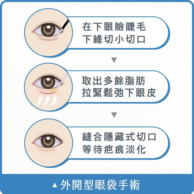 眼袋_外開型眼袋手術_首爾醫美診所