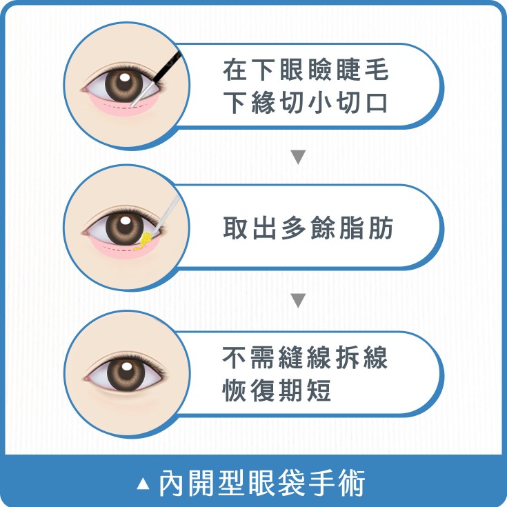 眼袋_內開型眼袋手術_首爾醫美診所