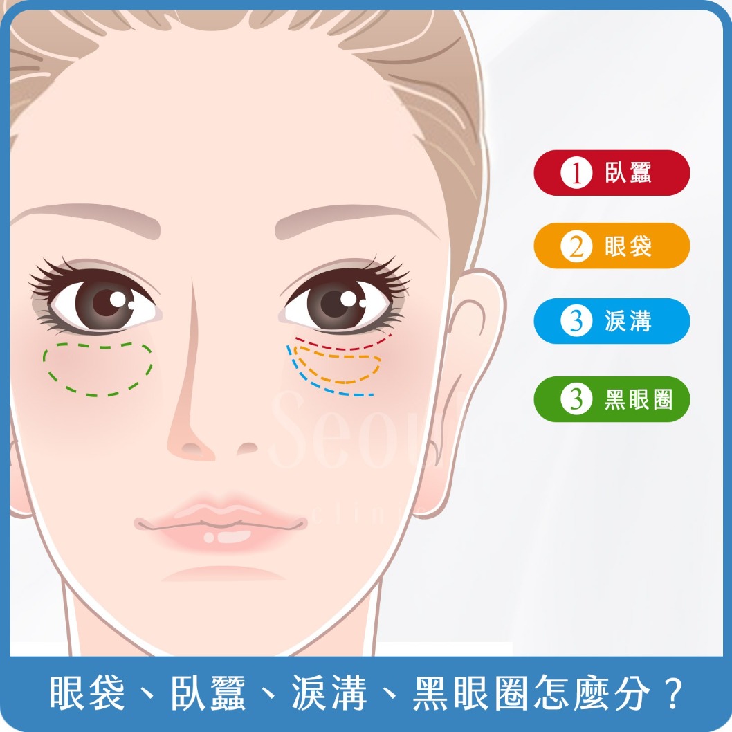 眼袋-眼袋、淚溝、臥蠶怎麼分？-首爾醫美