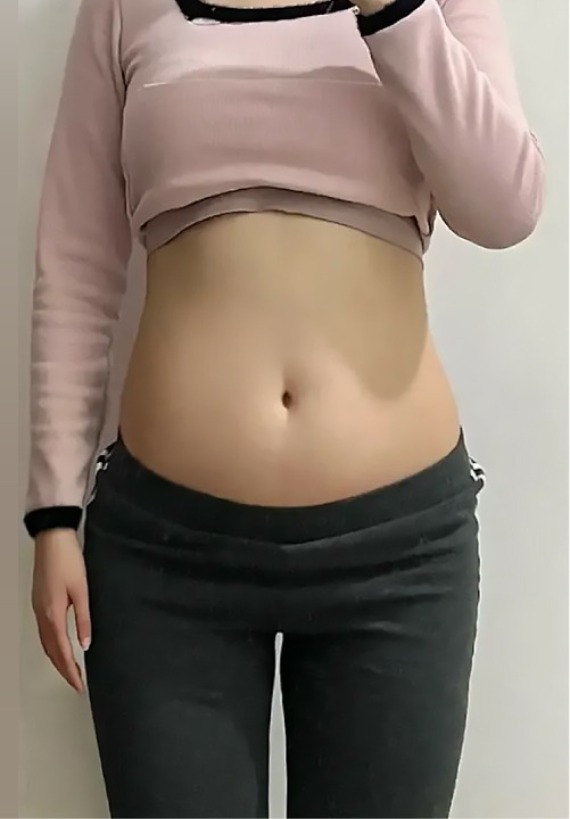 首爾醫美抽脂手術_術後分享照