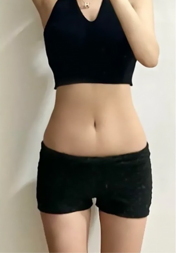 首爾醫美抽脂手術_術後分享照