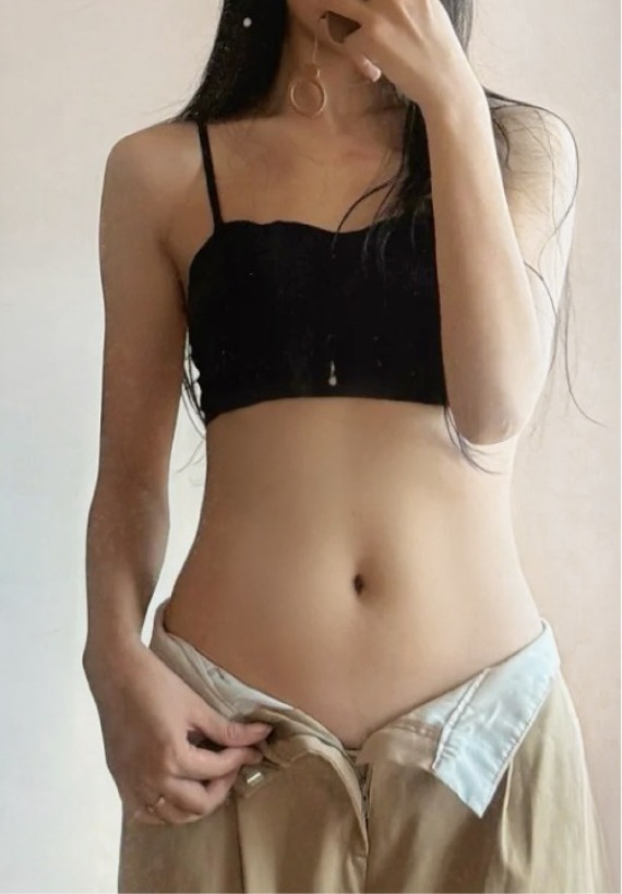 首爾醫美抽脂手術_術後分享照