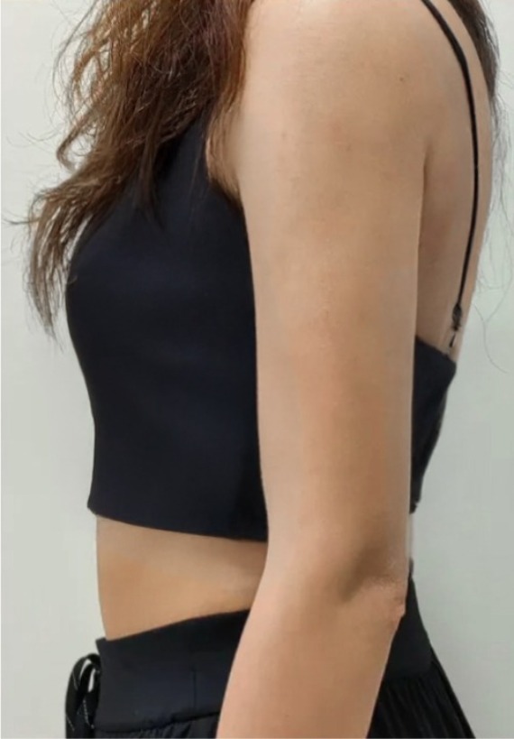 首爾醫美抽脂手術_術後分享照