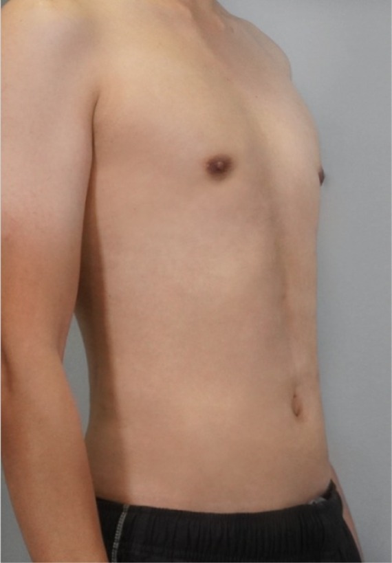 首爾醫美抽脂手術_術後分享照