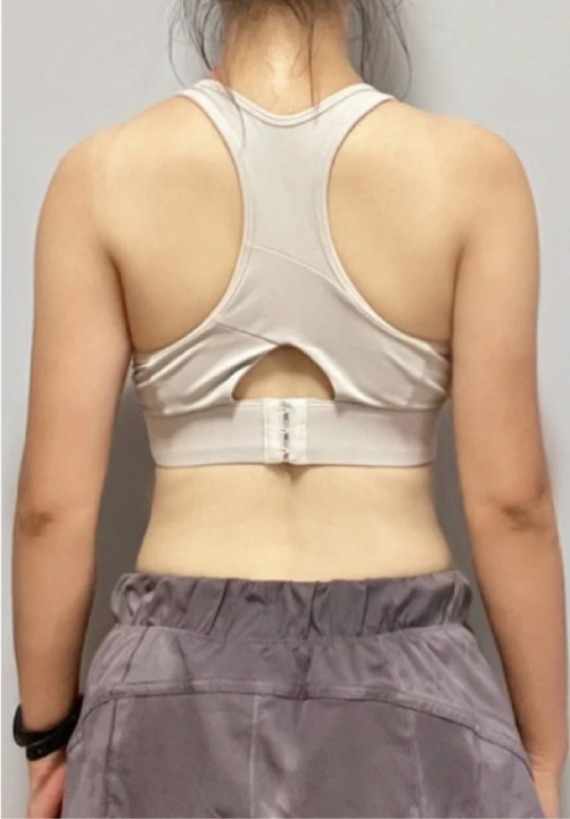 首爾醫美抽脂手術_術後分享照