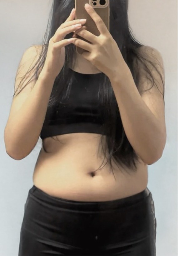 首爾醫美抽脂手術_術後分享照