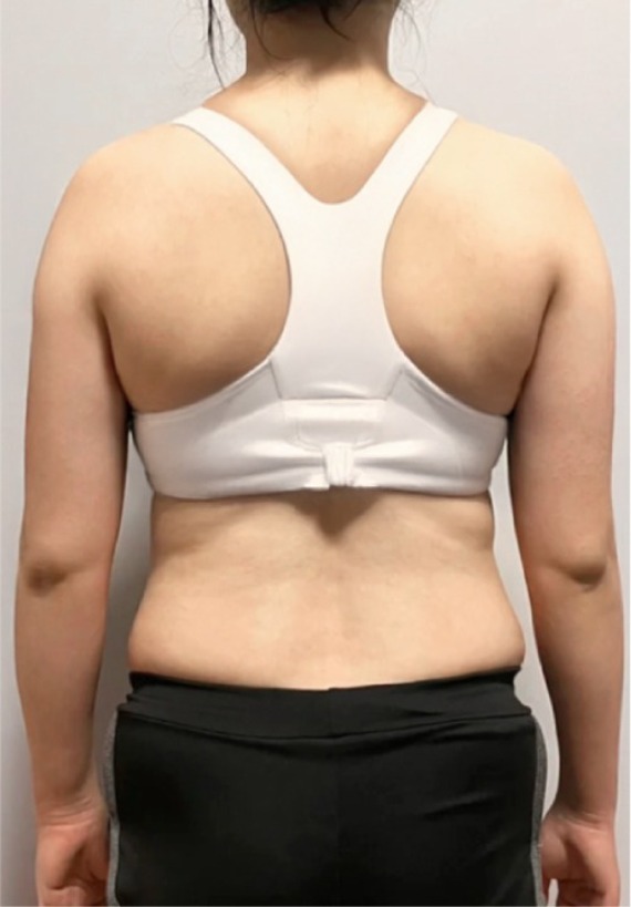 首爾醫美抽脂手術_術後分享照