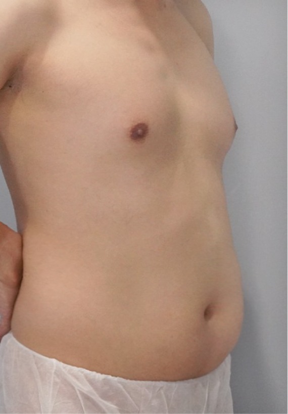 首爾醫美抽脂手術_術後分享照