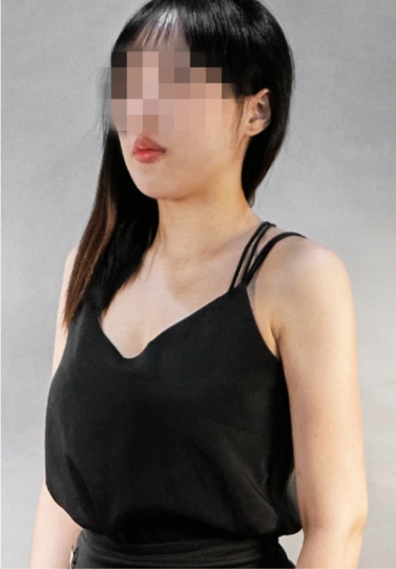 首爾醫美抽脂手術_術後分享照