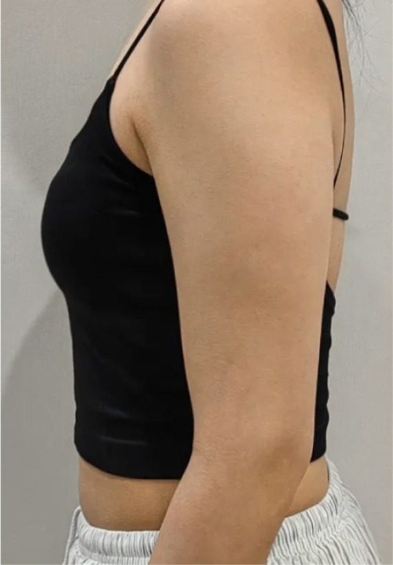 首爾醫美抽脂手術_術後分享照