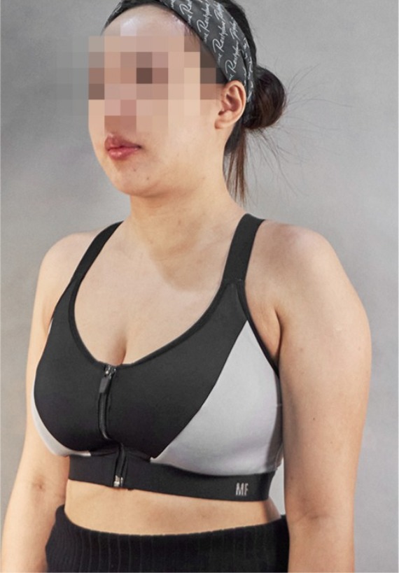 首爾醫美抽脂手術_術後分享照