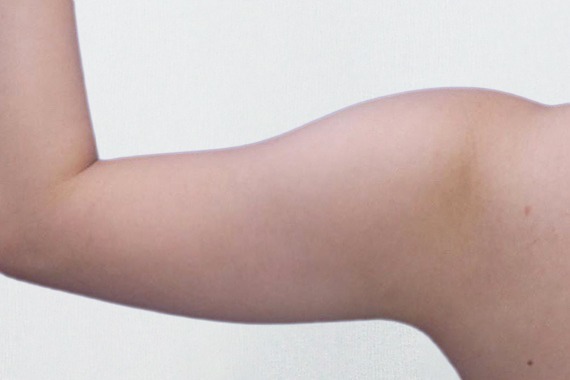 首爾醫美抽脂手術_術前分享照