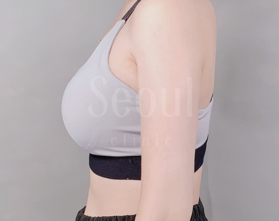 首爾醫美抽脂手術_術前分享照