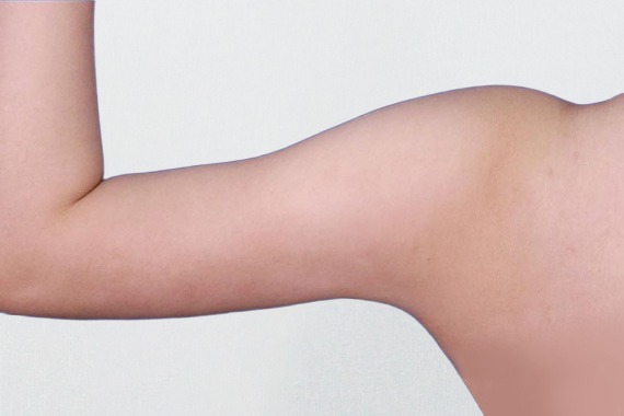 首爾醫美抽脂手術_術後分享照