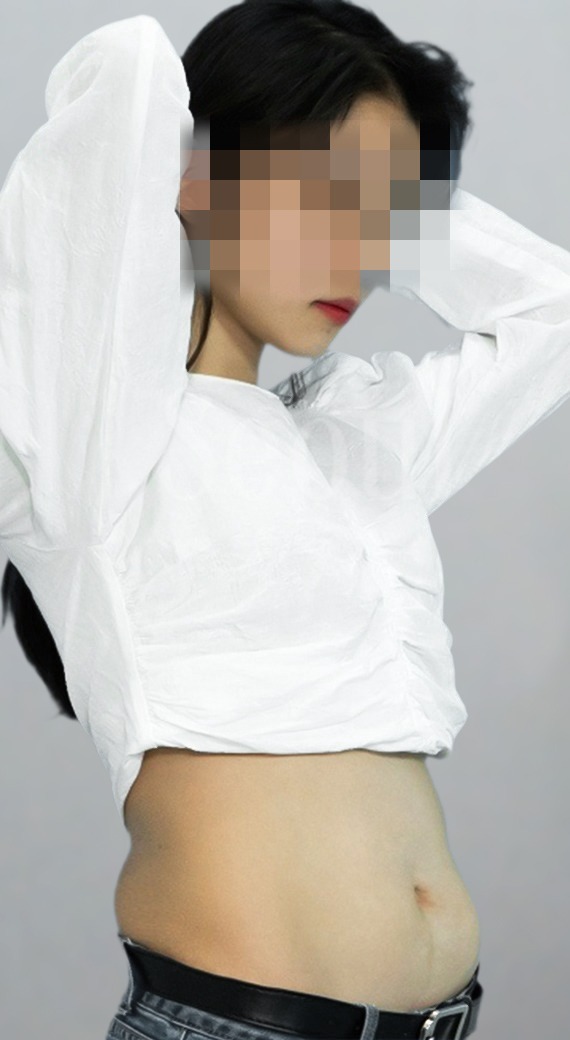 首爾醫美抽脂手術_術前分享照