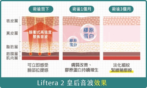 皇后音波-治療效果-首爾醫美