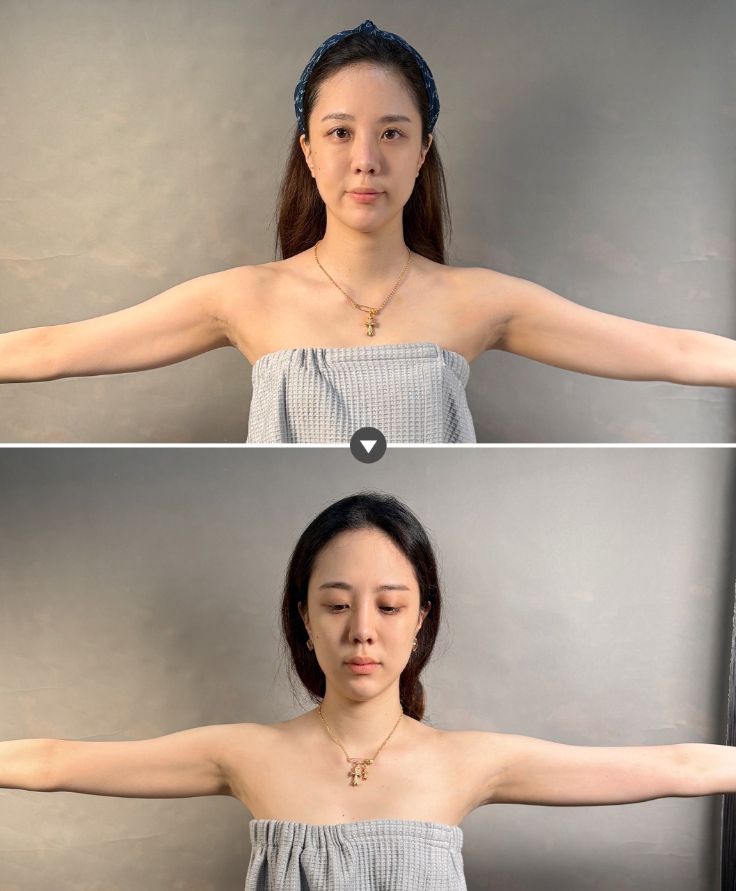 消脂針_術前術後_首爾醫美