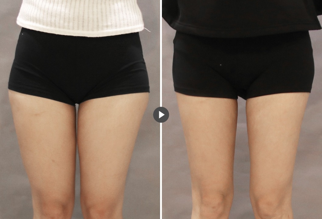 消脂針_術前術後_首爾醫美