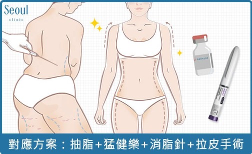 消脂針-重度肥胖皮膚鬆弛，對應方案：善纖達+消脂針+抽脂+拉皮手術-首爾醫美