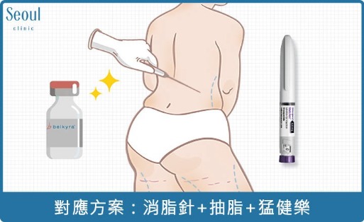 消脂針-中度大範圍肥胖，對應方案：善纖達+消脂針+抽脂-首爾醫美