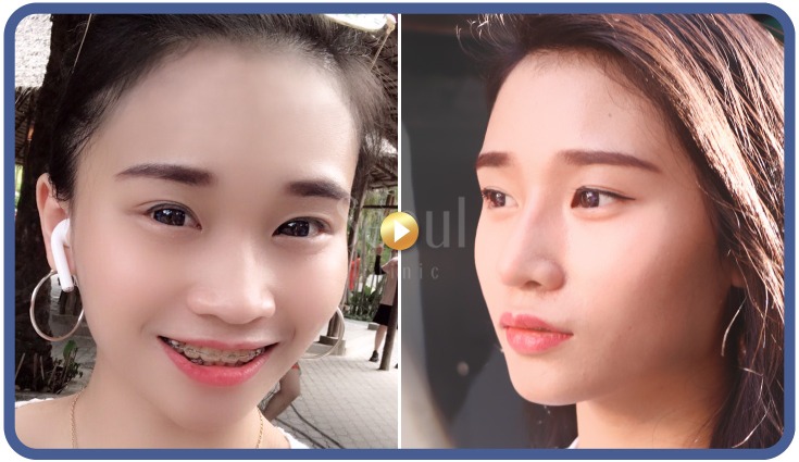 首爾醫美隆鼻手術_素人實證 首爾醫美隆鼻手術_素人實證