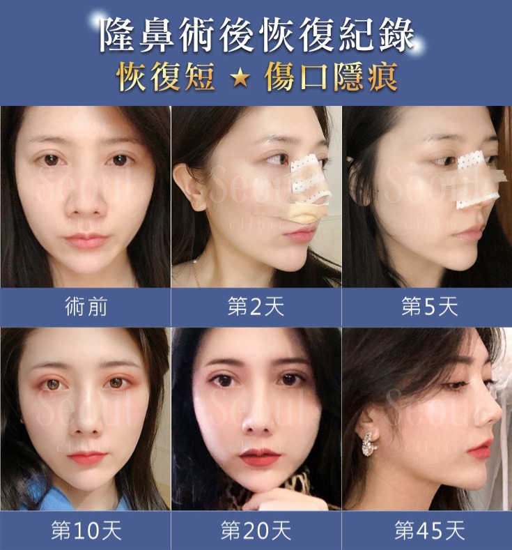 首爾醫美隆鼻手術_素人實證 首爾醫美隆鼻手術_素人實證