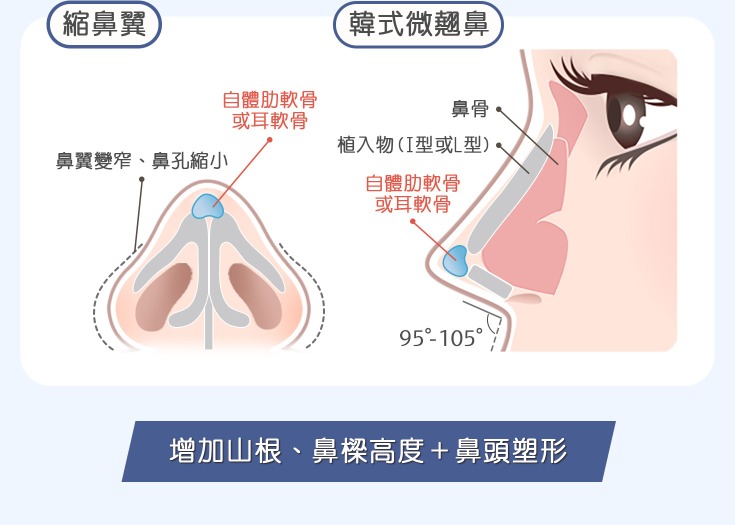 五合一隱痕眼袋手術-剩餘的脂肪不浪費，用於鋪平淚溝-首爾醫美診所