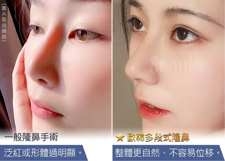 首爾醫美隆鼻手術_隆鼻示意圖 首爾醫美隆鼻手術_隆鼻示意圖