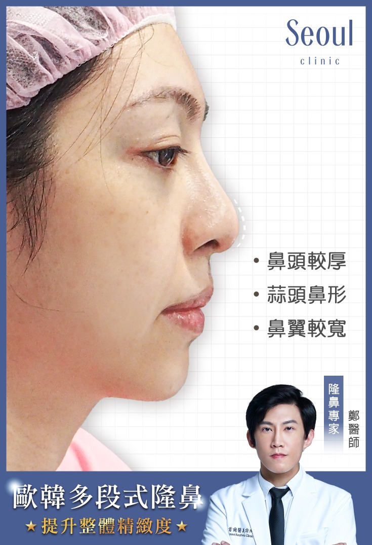 五合一隱痕眼袋手術-眼袋紅腫,加上淚溝,疲憊感倍增-首爾醫美診所 五合一隱痕眼袋手術-眼袋紅腫,加上淚溝,疲憊感倍增-首爾醫美診所