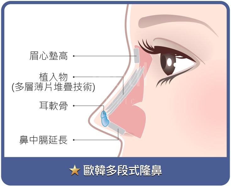 首爾醫美隆鼻手術_隆鼻示意圖 首爾醫美隆鼻手術_隆鼻示意圖