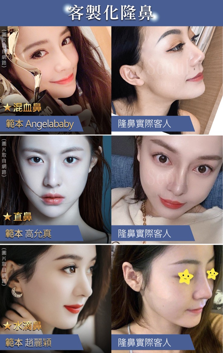 首爾醫美隆鼻手術_客製化隆鼻 首爾醫美隆鼻手術_客製化隆鼻