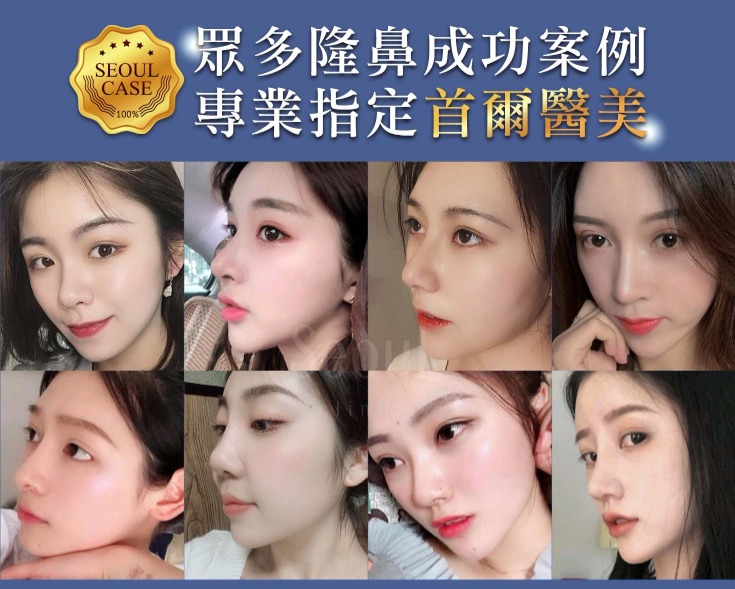 首爾醫美隆鼻手術_成功案例