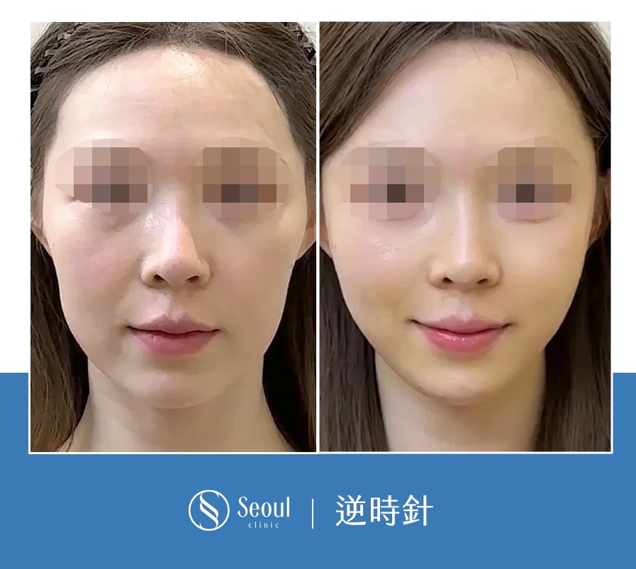 逆時針-逆時針臉部術後效果-首爾醫美診所 逆時針-逆時針臉部術後效果-首爾醫美診所