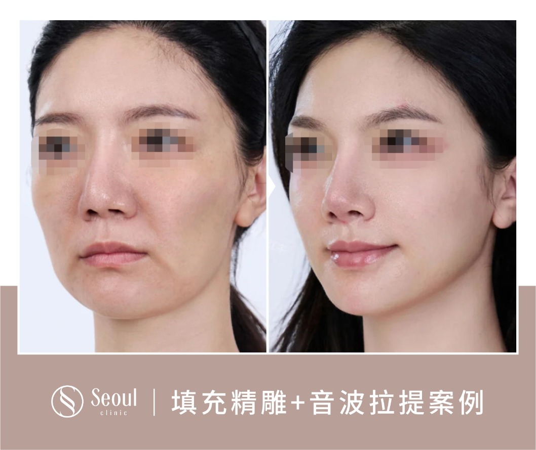 猛健樂臉-電波拉提案例前後-首爾醫美診所