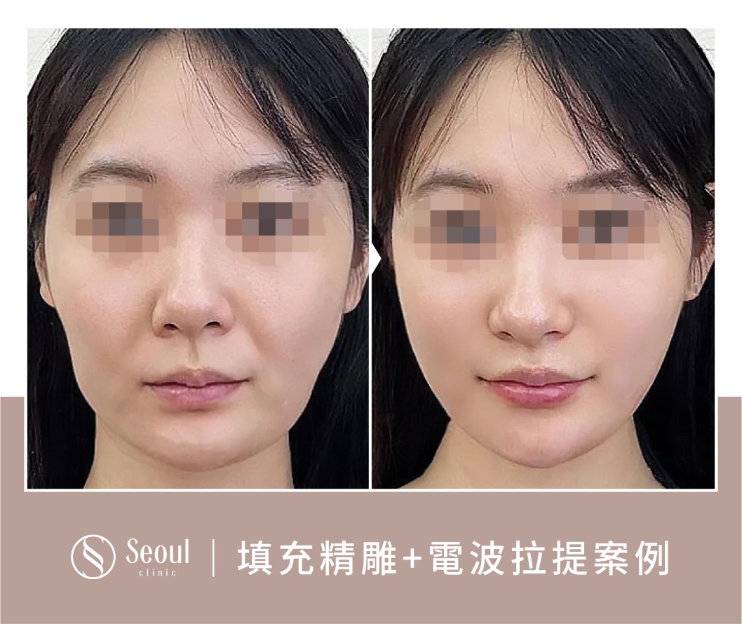 猛健樂臉-喬雅露案例前後-首爾醫美診所