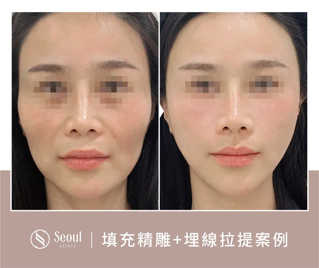 猛健樂臉-埋線案例前後-首爾醫美診所